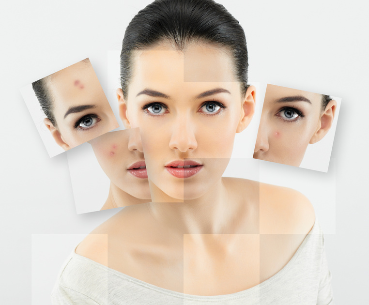 Frau mit Hautunreinheiten Gesicht. - Solche Hautunreinheiten können mit der Basic Gesichtsbehandlung behoben werden.